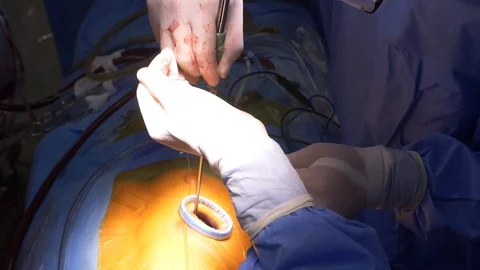 Heart needling Stock Footage 118889275