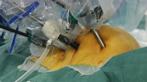 Heart operation 스톡 동영상 10915097