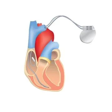 Heart pacemaker in work. Human heart anatomy with ICD Stock Illustration