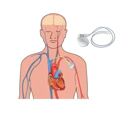 Heart pacemaker in work. Human heart artificial cardiac, ICD Stock Illustration