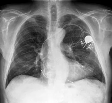 Heart pacemaker, x-ray Stock Photos