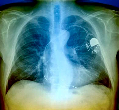 Heart pacemaker, x-ray 스톡 사진