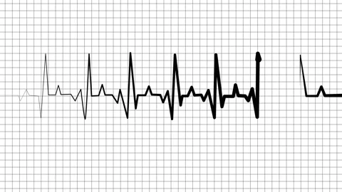 Heart rhythm line showing an electrocardiogram pattern medical background w.. Stock-Footage 336905301