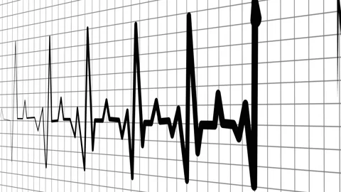Heart rhythm line showing an electrocardiogram pattern medical background w.. Stock Footage 336905312