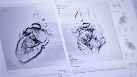 Heart scan front, side view animation. Digital artifacts, dynamic glitches Stock Footage 158150285