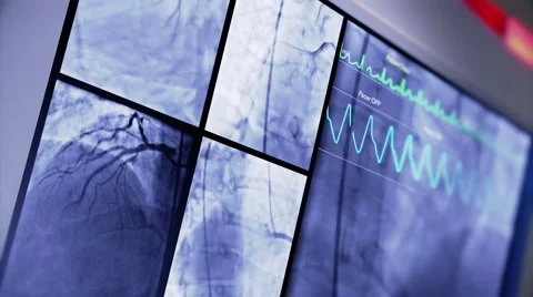 Heart Scanner on Hospital Monitor Stock Footage