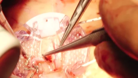 Heart surgery close-up Stock Footage 130377293