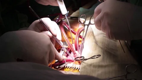 Heart surgery. closeup doctors hands operating a kid`s heart. child Video stock 70810242