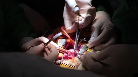 Heart surgery. closeup doctors hands operating a kid`s heart. child Video stock 70810313