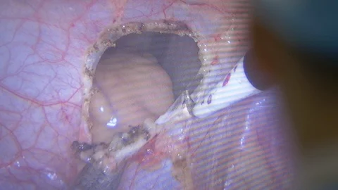 Heart surgery Stock Footage 118898520