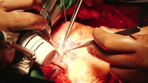 Heart surgery Stock Footage 130373988
