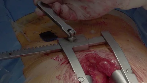 Heart surgery. Installation of a retractor. Close-up Video stock 104925208
