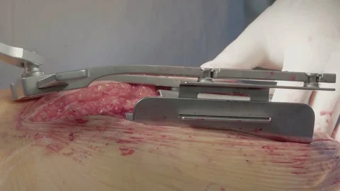 Heart surgery. Installation of a retractor. Close-up Vídeo Stock 104925284