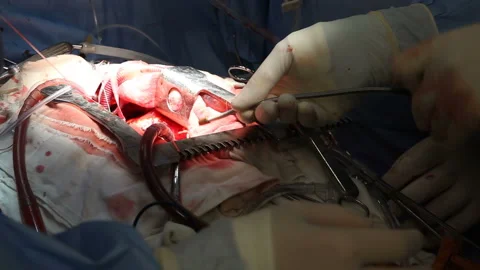 Heart surgery. Works in surgery. Stock Footage 86854577