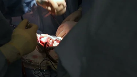 Heart surgery. Works in surgery. Stock Footage 86855147