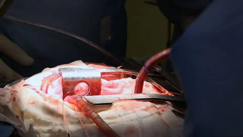 Heart surgery. Works in surgery. Stock Footage 86855387