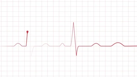 Heartbeat line electrocardiogram style pulse trace with sharp spikes and fl.. Stock Footage 340387150