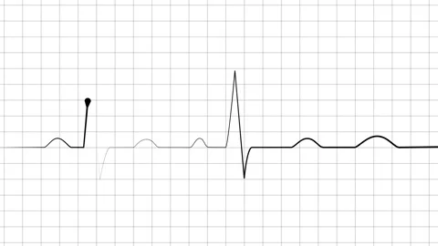 Heartbeat line electrocardiogram style pulse trace with sharp spikes and fl.. Stock Footage 340387178