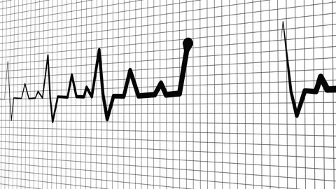Heartbeat line on graph paper showing an irregular ecg pattern with a flatl.. Stock Footage 336906735
