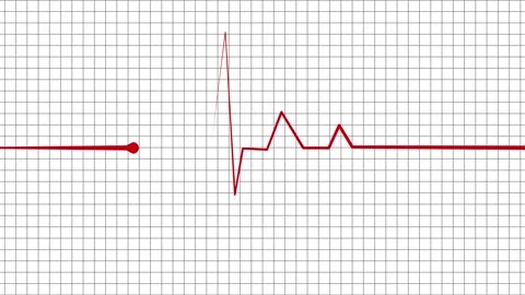 Heartbeat line with a single sharp spike and flat line showing a medical mo.. Stock Footage 337182399