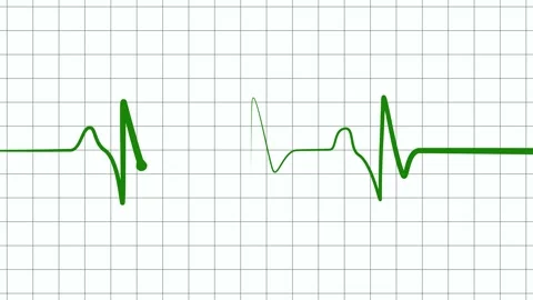 Heartbeat Line Wave Animation Featuring Continuous Pulse and Clear ECG Wave.. Stock-Footage 317647740