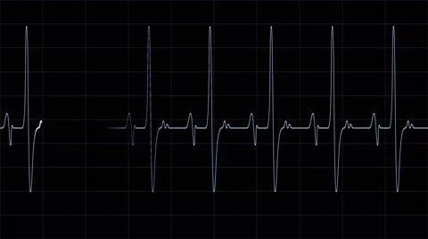 Heartbeat Monitor Line Stock Footage 59583418