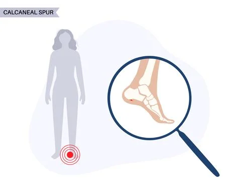 Heel spur poster Stock Illustration