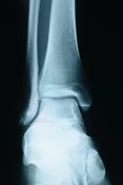 Heel xray Stock Photos