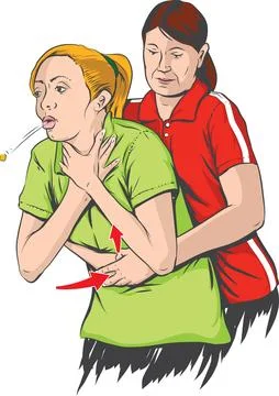 Heimlich Maneuver Stock Illustration