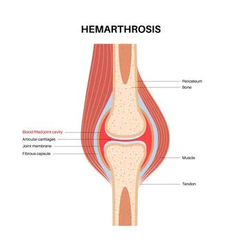 Hemarthrosis in the synovial joint Illustrazione stock