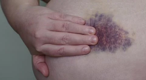 The hematoma is oval in shape on the body Stock Photos