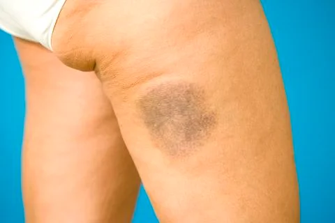 Hematoma Foto stock