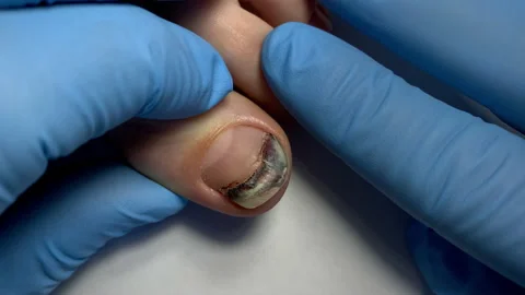 Hematoma under the nail 库存影片 152586513