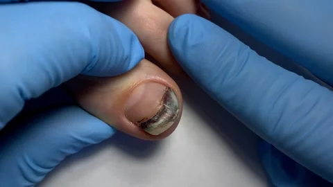 Hematoma under the nail Stock Footage 306557156