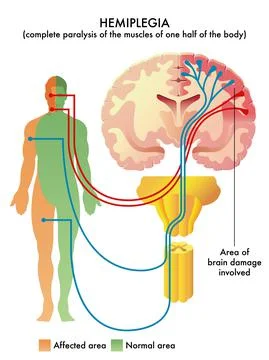 Hemiplegia Stock Illustration