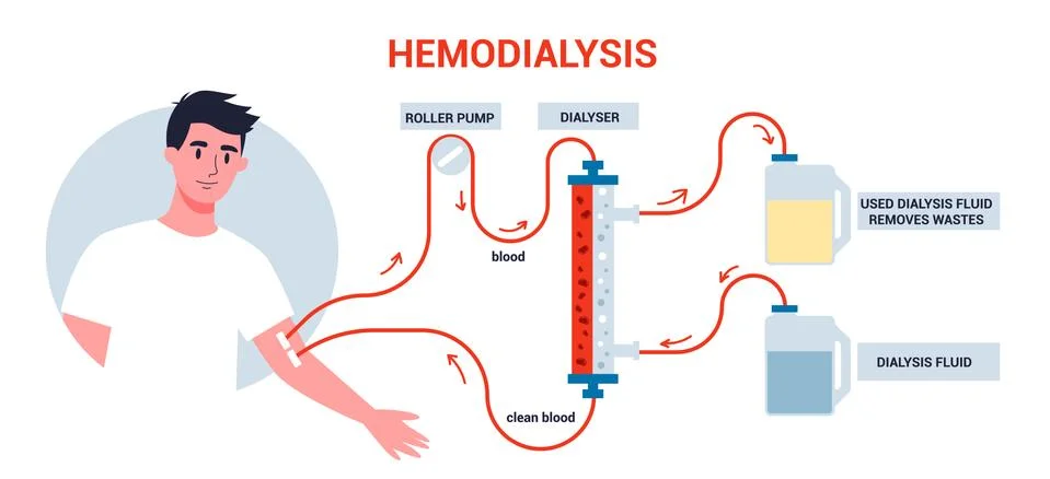 Hemodialysis for kidney treatment. Man get a kidney disease Stock Illustration