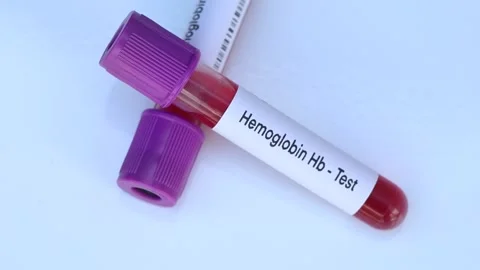 hemoglobin hb test to look for abnormali... | Stock Video | Pond5
