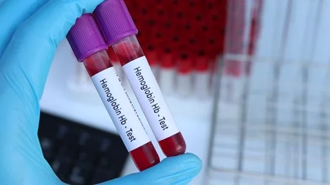 hemoglobin hb test to look for abnormali... | Stock Video | Pond5
