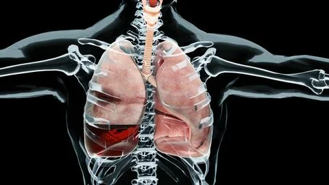 Hemopneumothorax, Normal lung versus collapsed, symptoms of Hemopneumothorax, Stock Illustration
