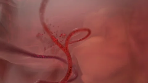 Hemorrhagic Stroke Stock Footage 125075745