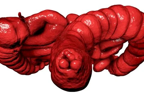 Hemorrhoids, bottom view of nodules inside anus, large and small intestine ar Stock Illustration