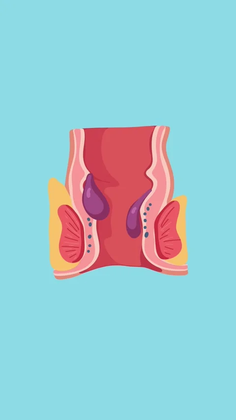Hemorrhoids consultation with proctologist animation Stock Footage 340956130