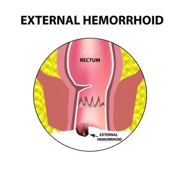 Hemorrhoids external. Rectum structure. Intestines. colon. Internal hemorrhoidal Stock Illustration