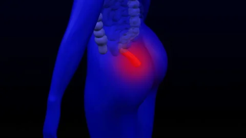 The hemorrhoids pain. 3D rendering. Stock Footage 172442586