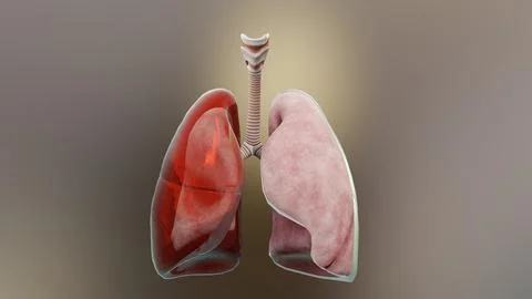 Hemothorax, Normal lung versus collapsed, pleural effusion, empyema, Stock Illustration
