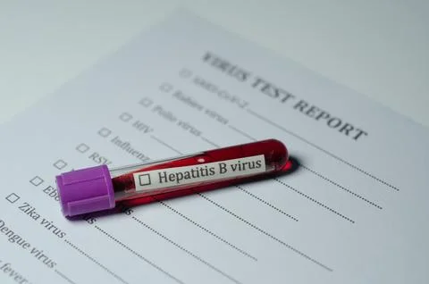 Hepatitis B Virus Test Sample Blood Vial on Medical Report Stock Photos