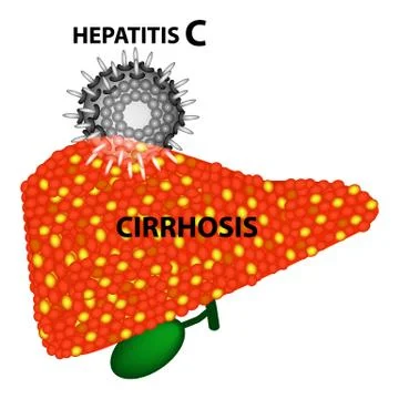 Hepatitis C leads to the development of cirrhosis in 97 percent of cases Stock Illustration