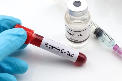 Hepatitis C test to look for abnormalities from blood Stockfoto's