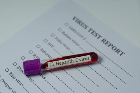 Hepatitis C Virus Test Sample on Medical Report Stock Photos