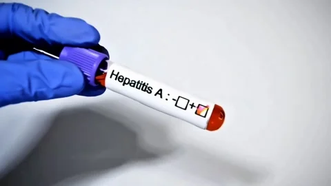 Hepatitis A test to look for abnormalities from blood Stock Footage 307314667